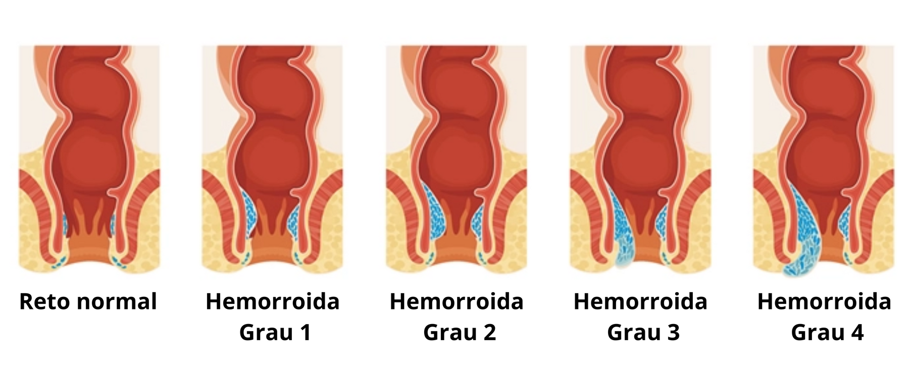 Pomada Dictamni Para Hemorroidas - [Compre 2 e Leve 3]