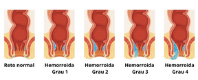 Pomada Dictamni Para Hemorroidas - [Compre 2 e Leve 3]