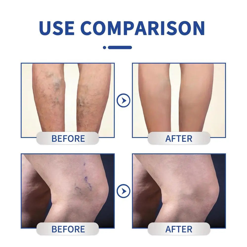 VaricoseCare Max