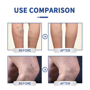 VaricoseCare Max
