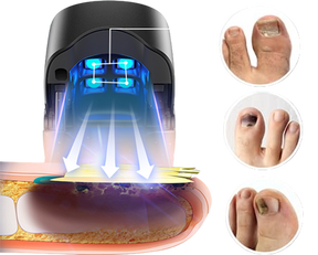 NexFungus 2.0 - Laserterapia Para Fungos nos Pés e Mãos