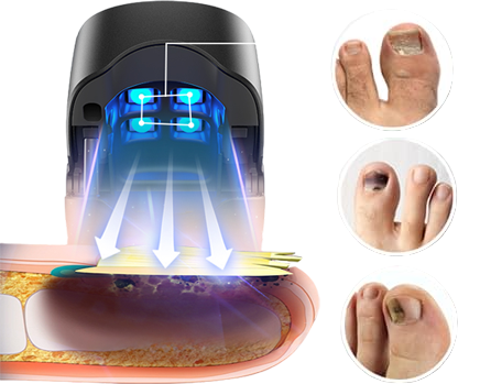 NexFungus 2.0 - Laserterapia Para Fungos nos Pés e Mãos